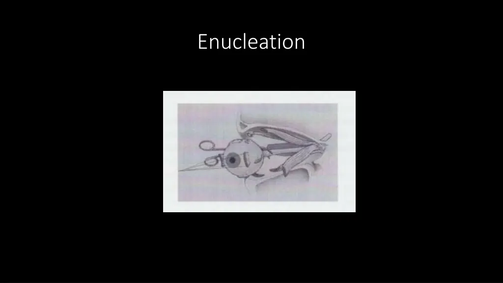 enucleation