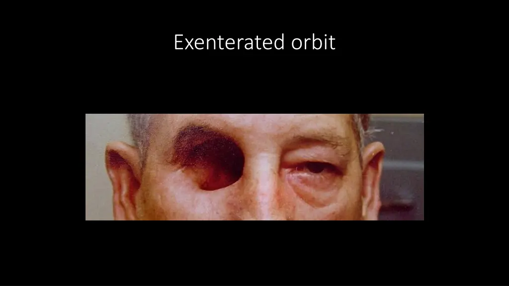 exenterated orbit