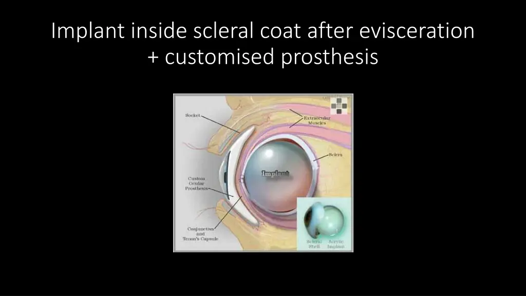 implant inside scleral coat after evisceration