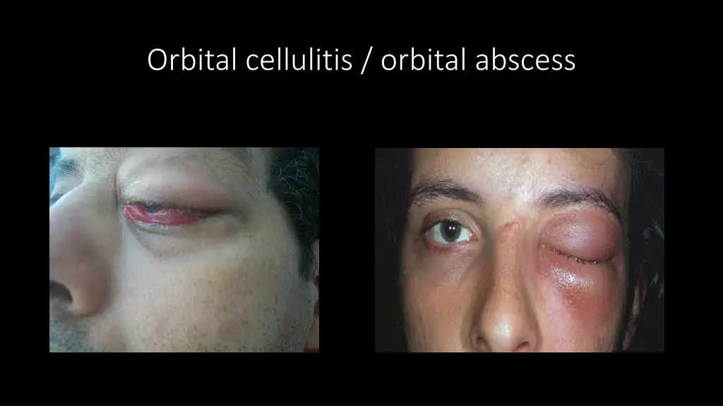 orbital cellulitis orbital abscess