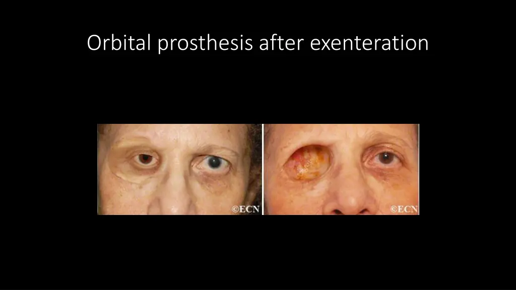 orbital prosthesis after exenteration