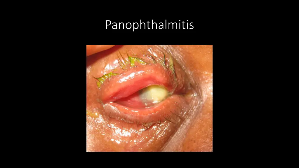 panophthalmitis
