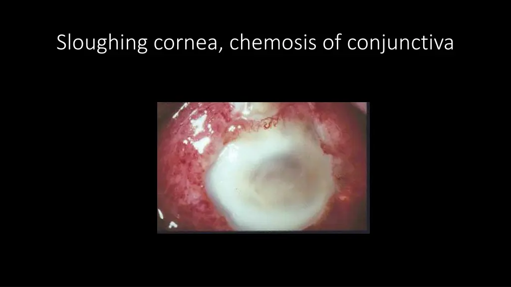 sloughing cornea chemosis of conjunctiva
