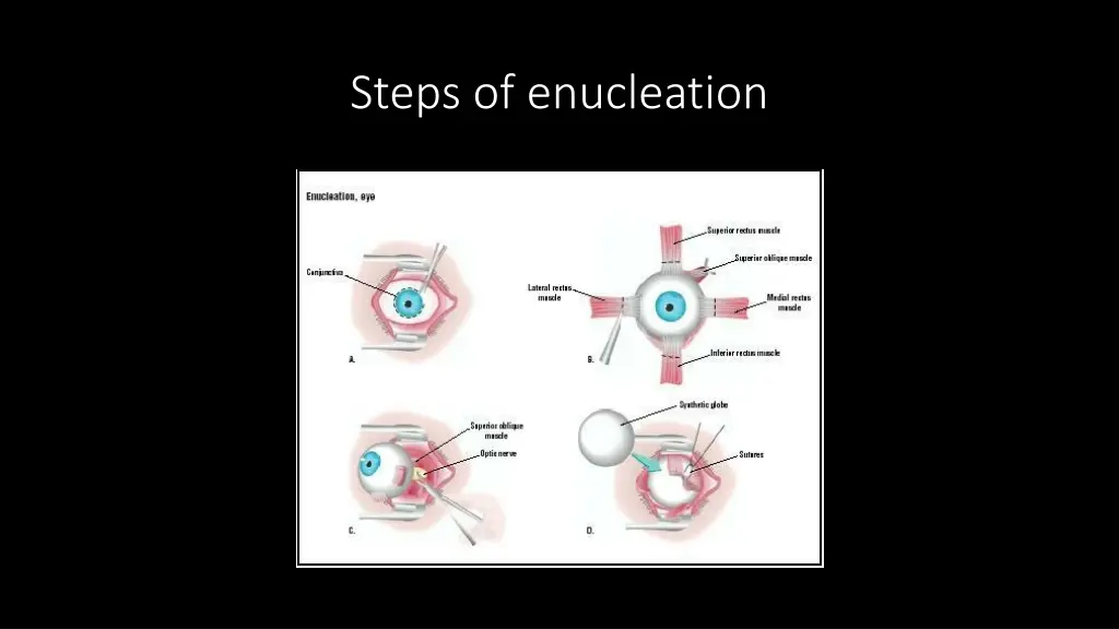 steps of enucleation