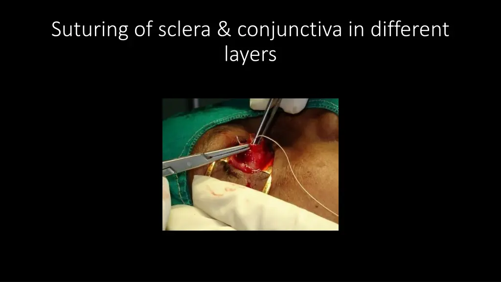suturing of sclera conjunctiva in different layers
