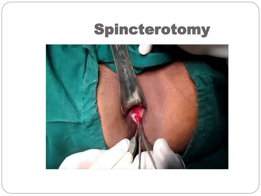 spincterotomy spincterotomy