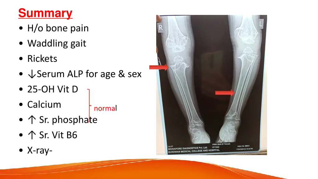 summary h o bone pain waddling gait rickets serum