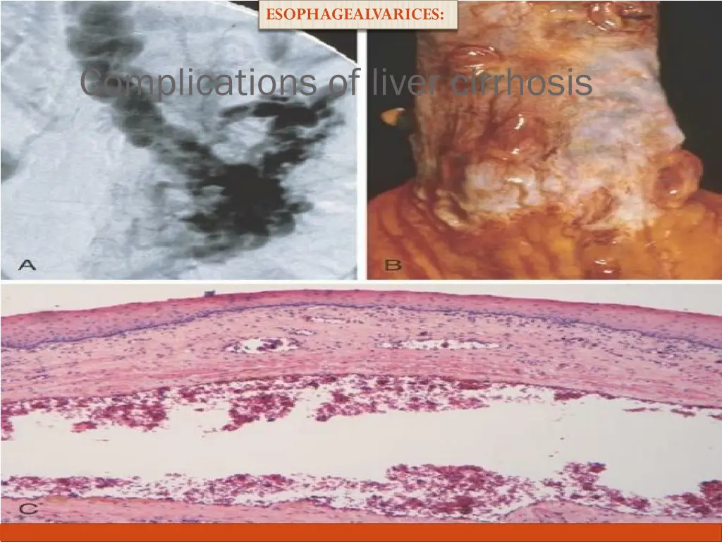 esophagealvarices