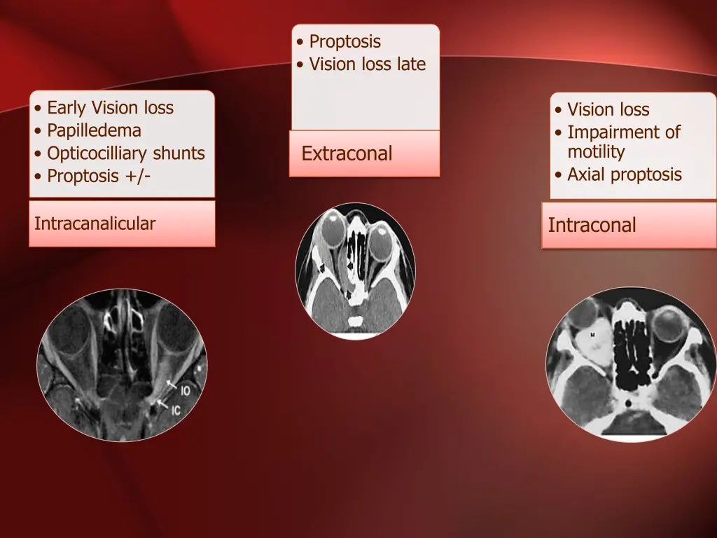 proptosis vision loss late