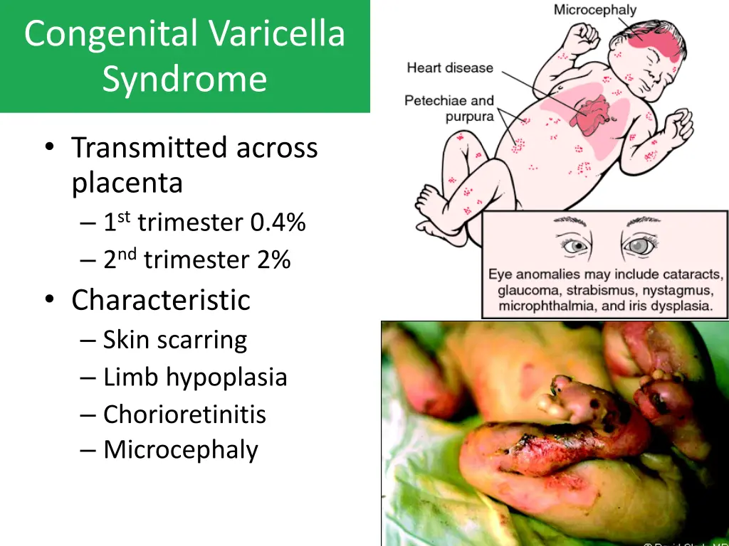congenital varicella syndrome