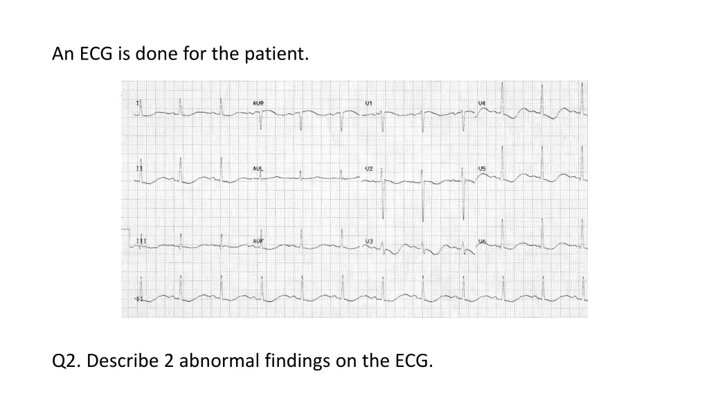 an ecg is done for the patient