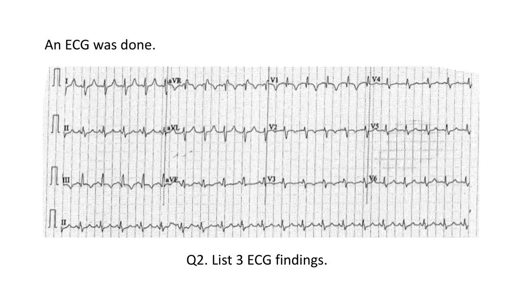 an ecg was done