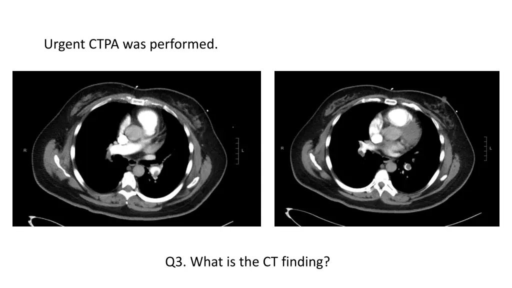 urgent ctpa was performed