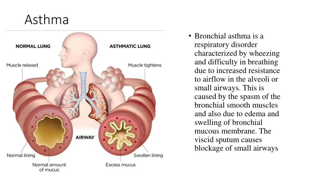 asthma