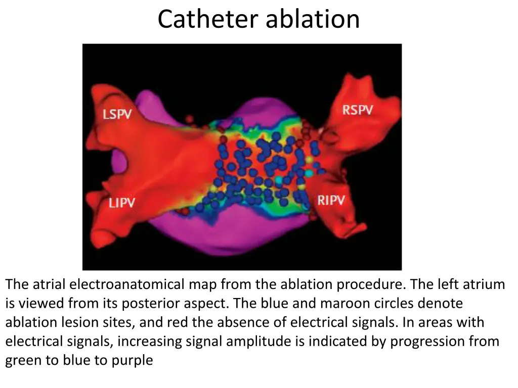 catheter ablation