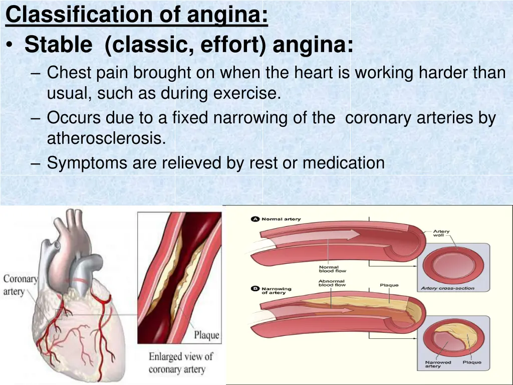 classification of angina stable classic effort
