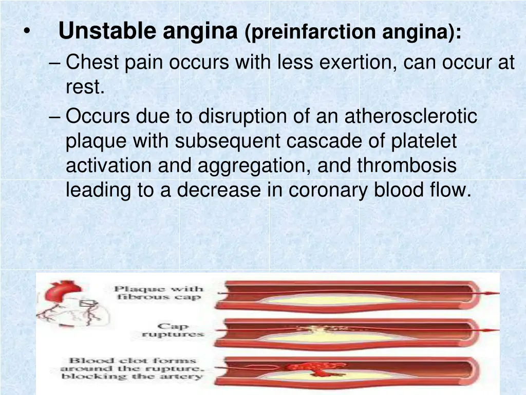 unstable angina preinfarction angina chest pain