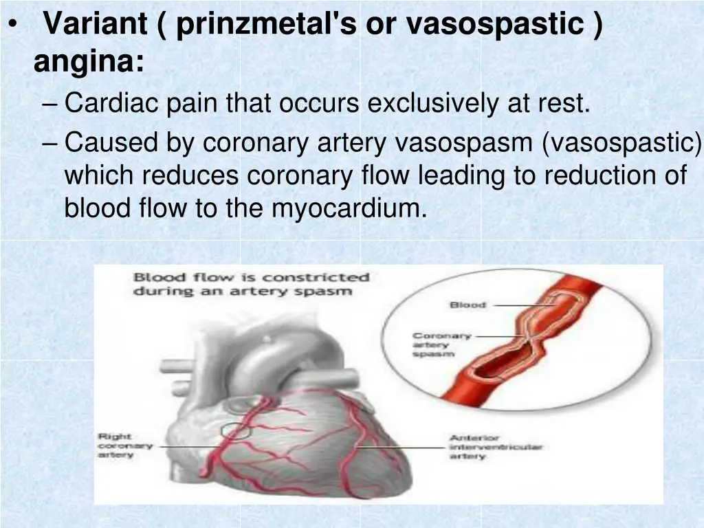 variant prinzmetal s or vasospastic angina