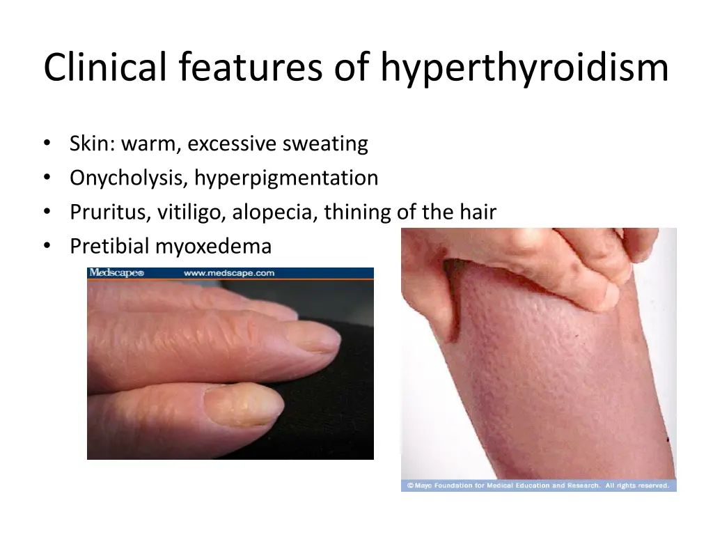 clinical features of hyperthyroidism