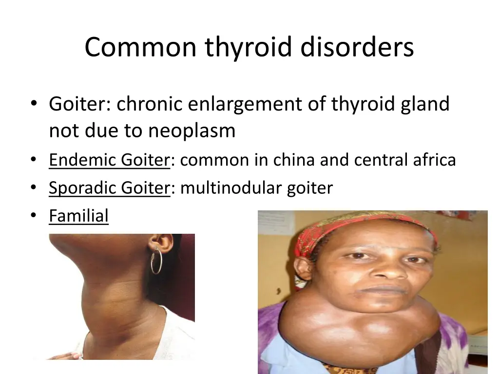 common thyroid disorders