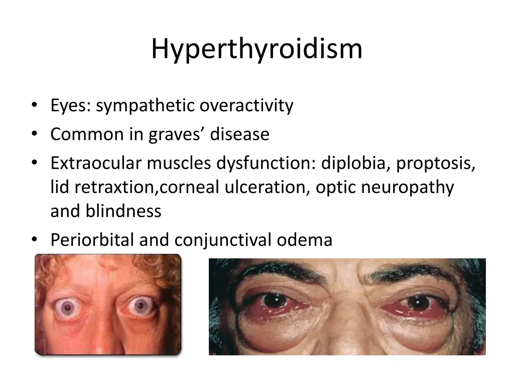 hyperthyroidism 1