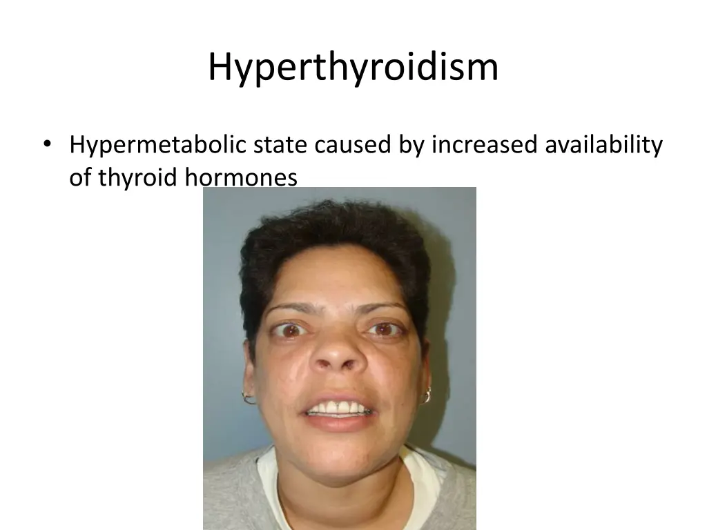 hyperthyroidism