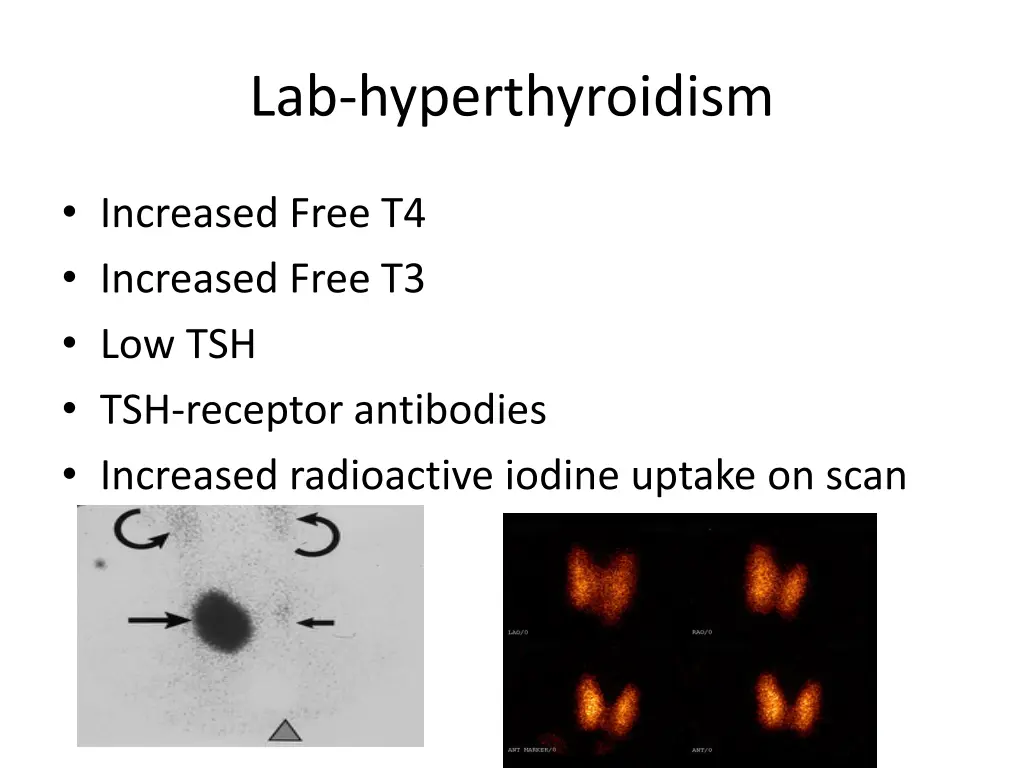 lab hyperthyroidism