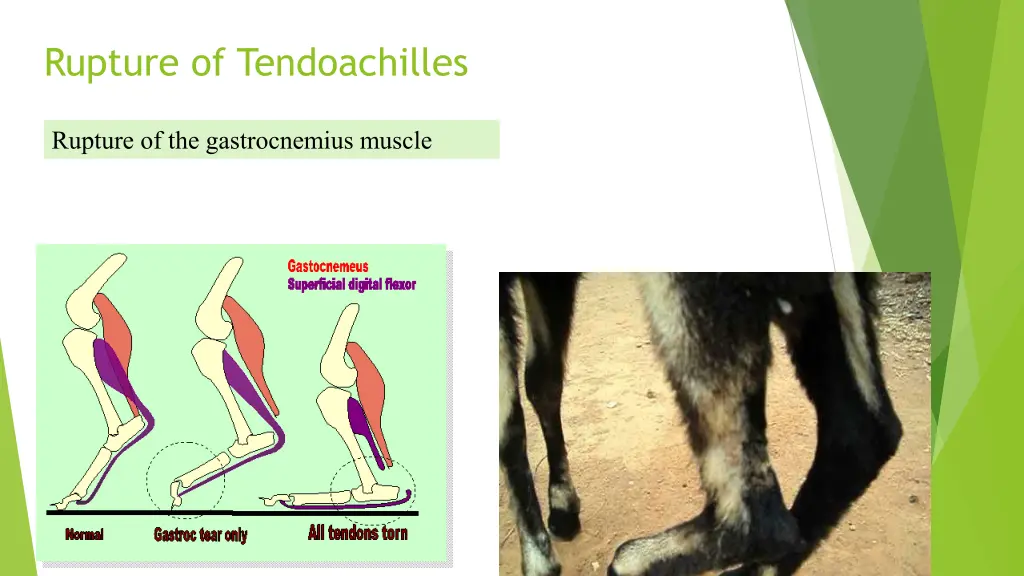 rupture of tendoachilles