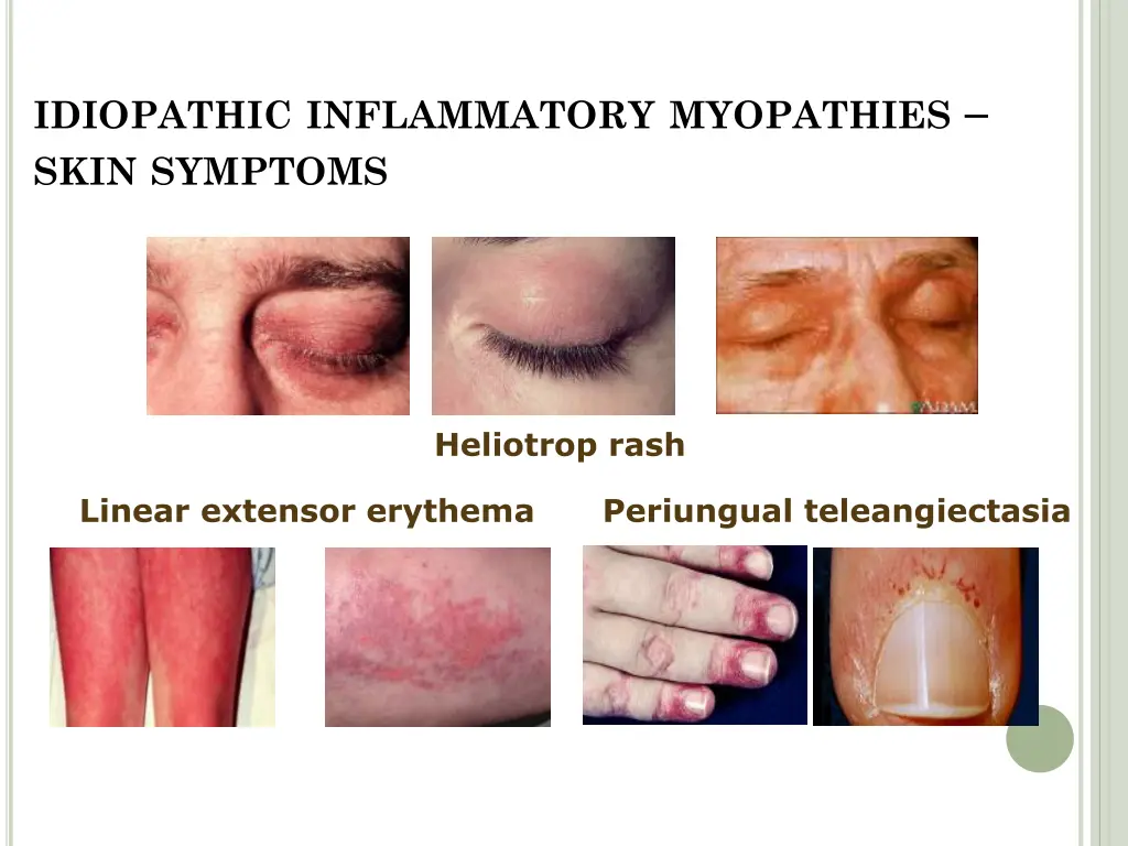 idiopathic inflammatory myopathies skin symptoms 1