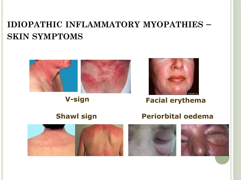 idiopathic inflammatory myopathies skin symptoms 2