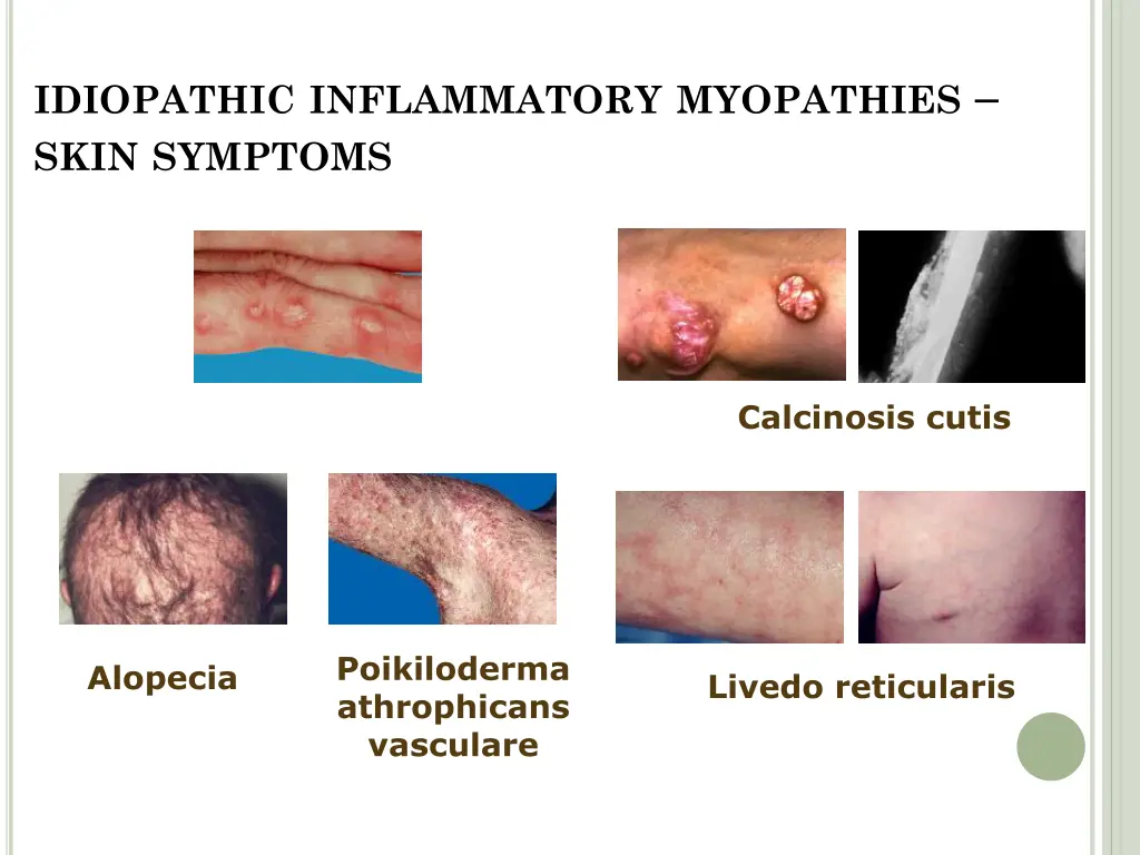 idiopathic inflammatory myopathies skin symptoms 3