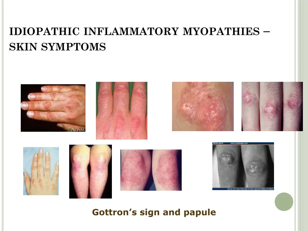 idiopathic inflammatory myopathies skin symptoms