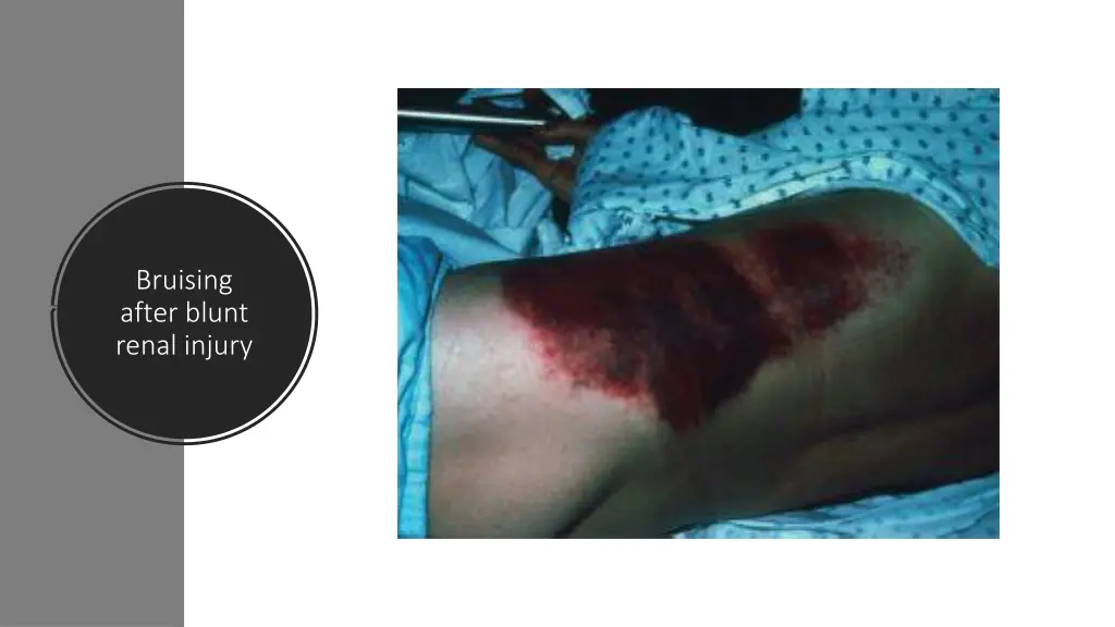 bruising after blunt renal injury