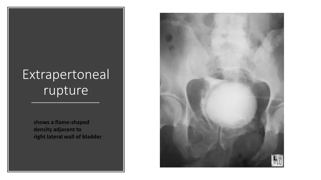 extrapertoneal rupture