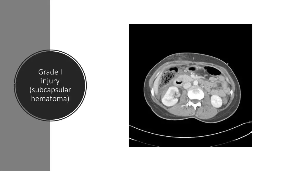 grade i injury subcapsular hematoma