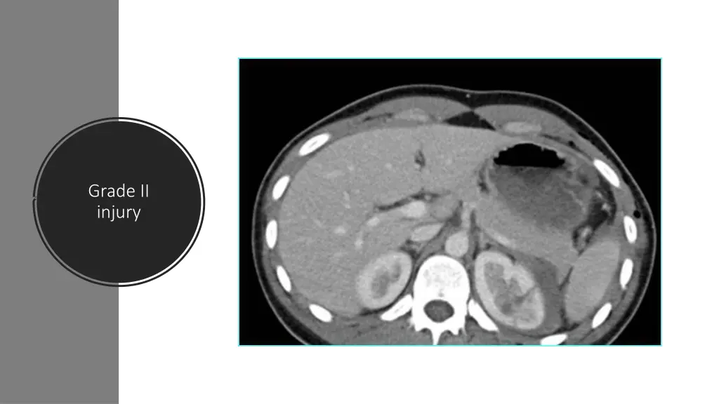 grade ii injury