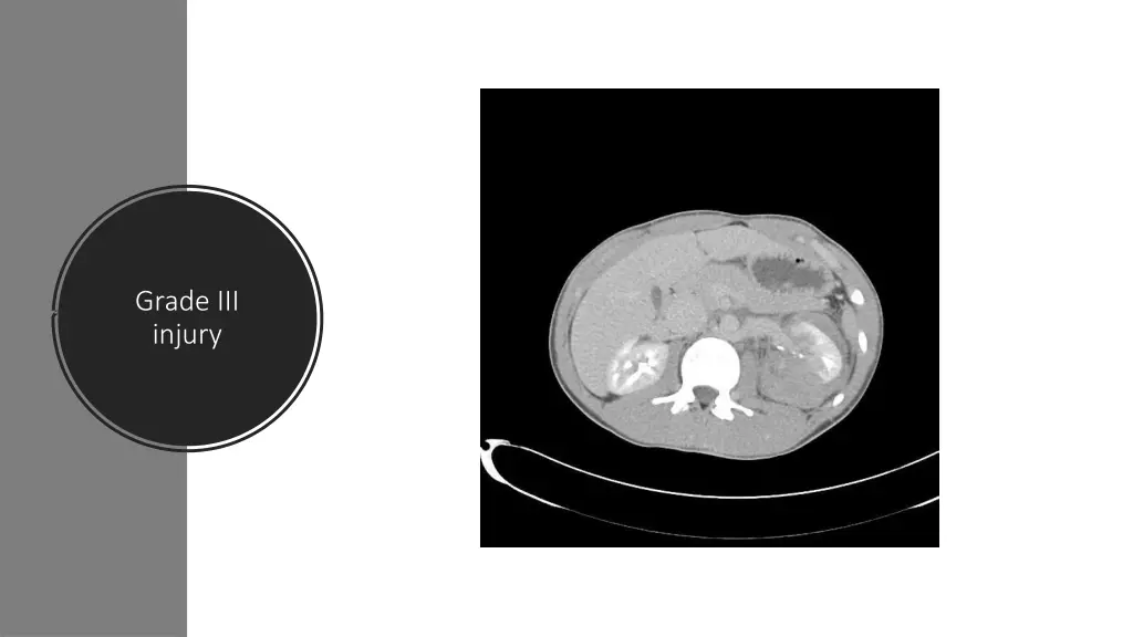 grade iii injury