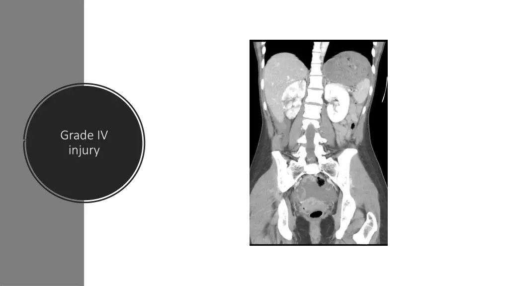 grade iv injury