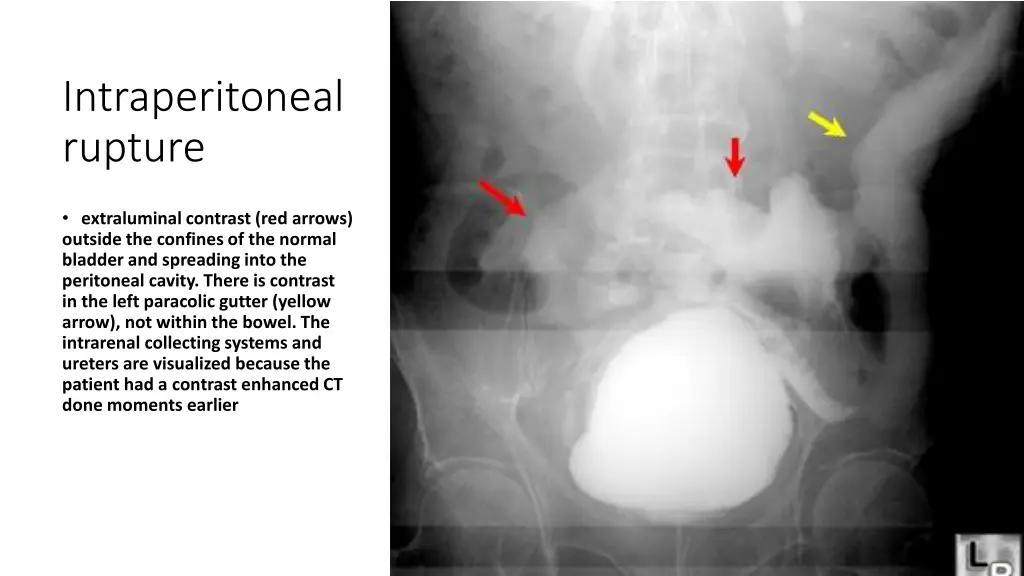 intraperitoneal rupture