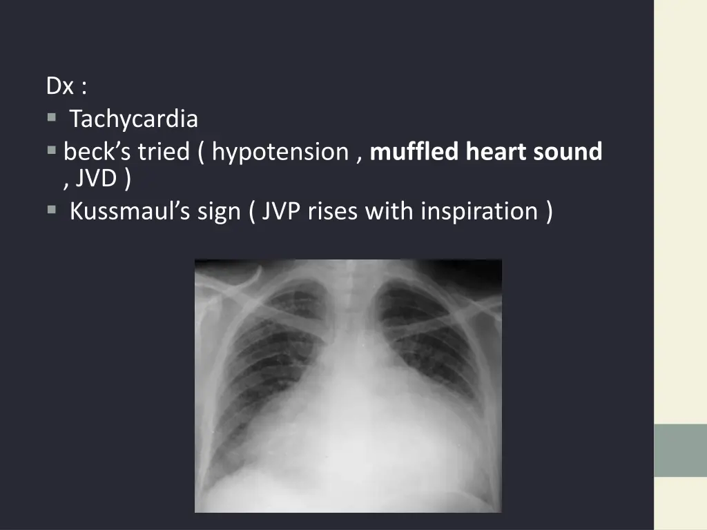 dx tachycardia beck s tried hypotension muffled