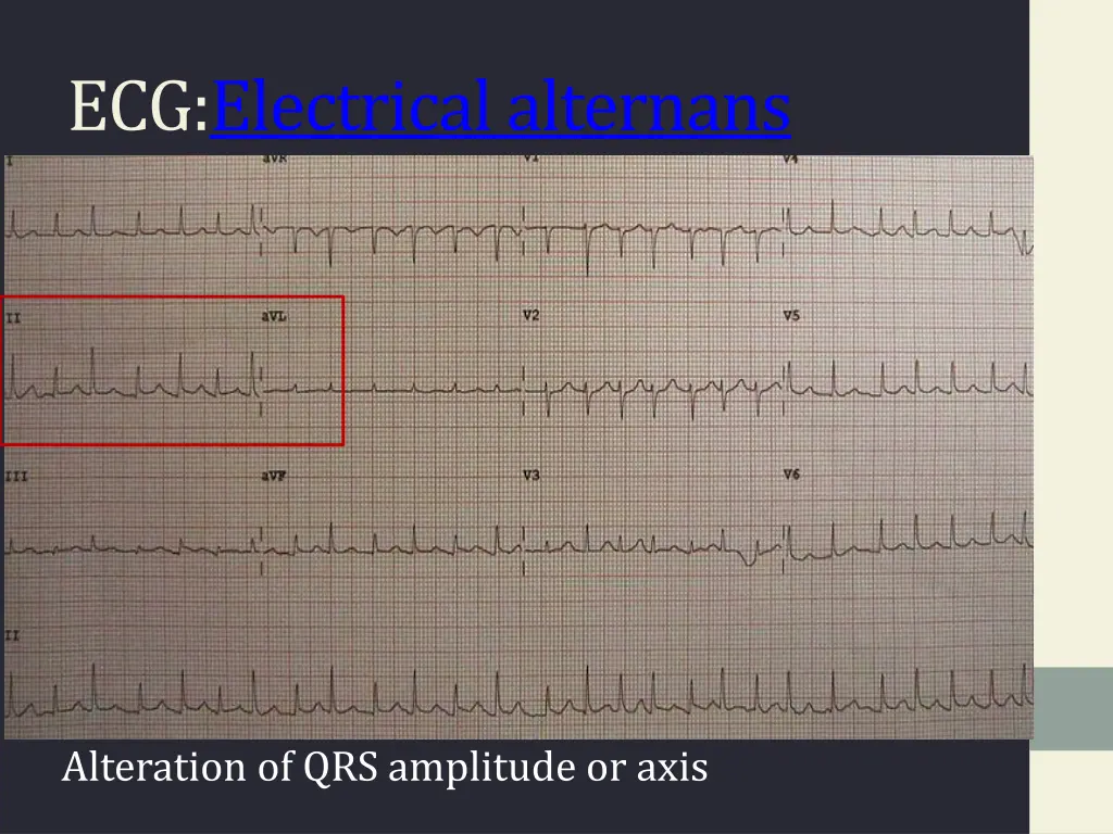 ecg electrical alternans