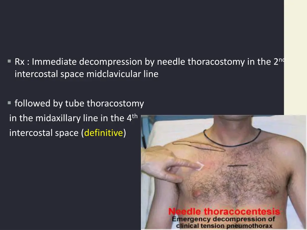 rx immediate decompression by needle thoracostomy