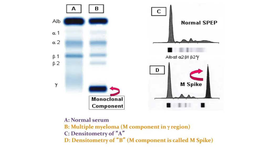 a normal serum b multiple myeloma m component