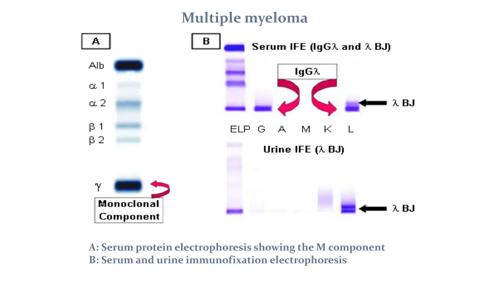 multiple myeloma