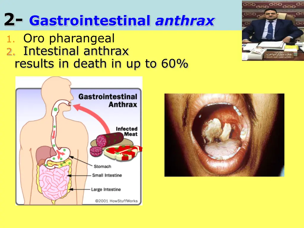 2 gastrointestinal anthrax 1 oro pharangeal