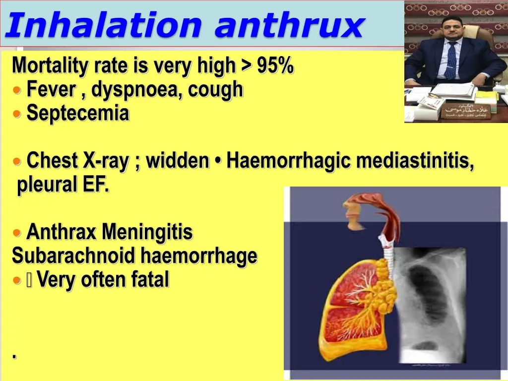 inhalation anthrux mortality rate is very high