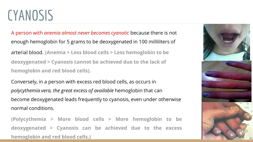 cyanosis 1