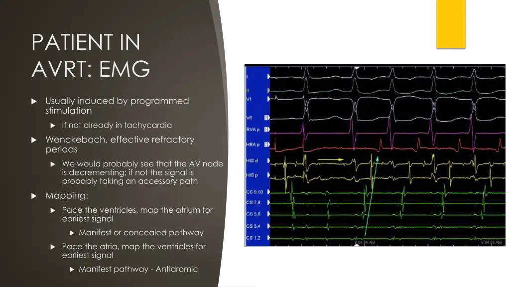 patient in avrt emg