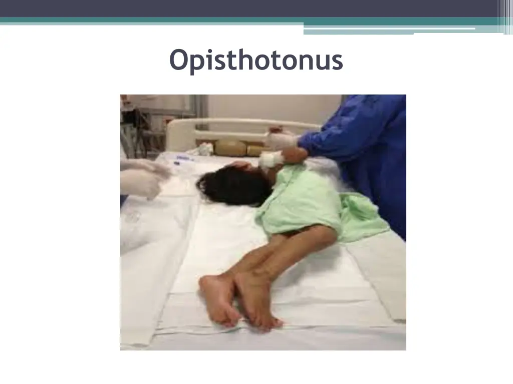 opisthotonus