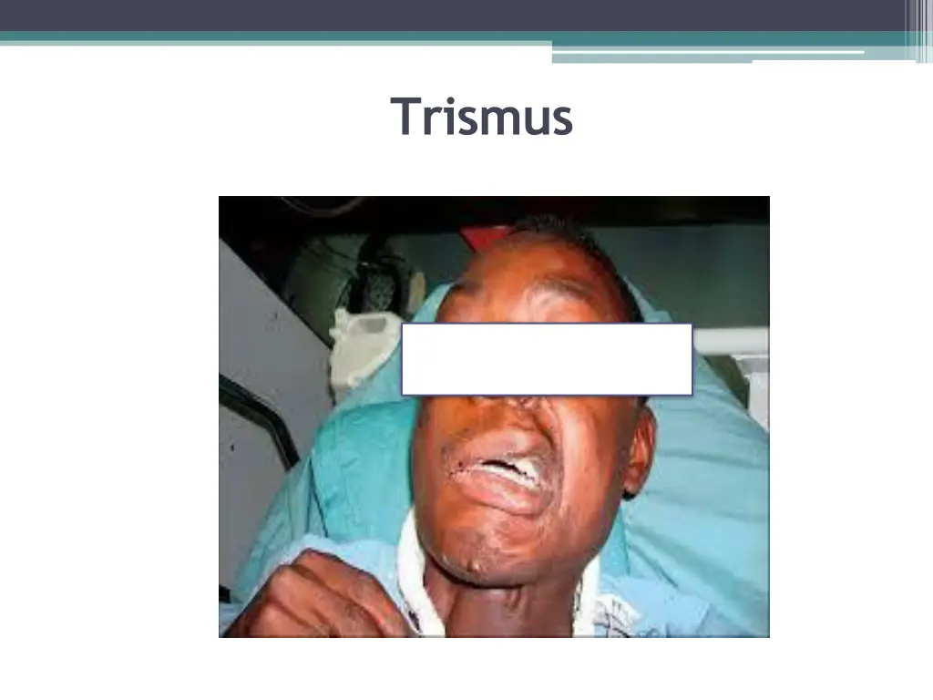 trismus